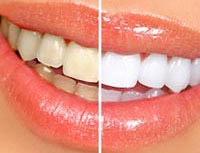 Cosmetic Dentistry - Whitening